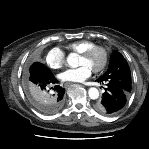 Follicular thyroid carcinoma - spinal metastasis | Image | Radiopaedia.org