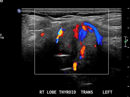 Follicular thyroid carcinoma - spinal metastasis | Radiology Case ...