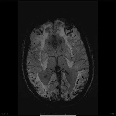 Cerebral Amyloid Angiopathy MRI