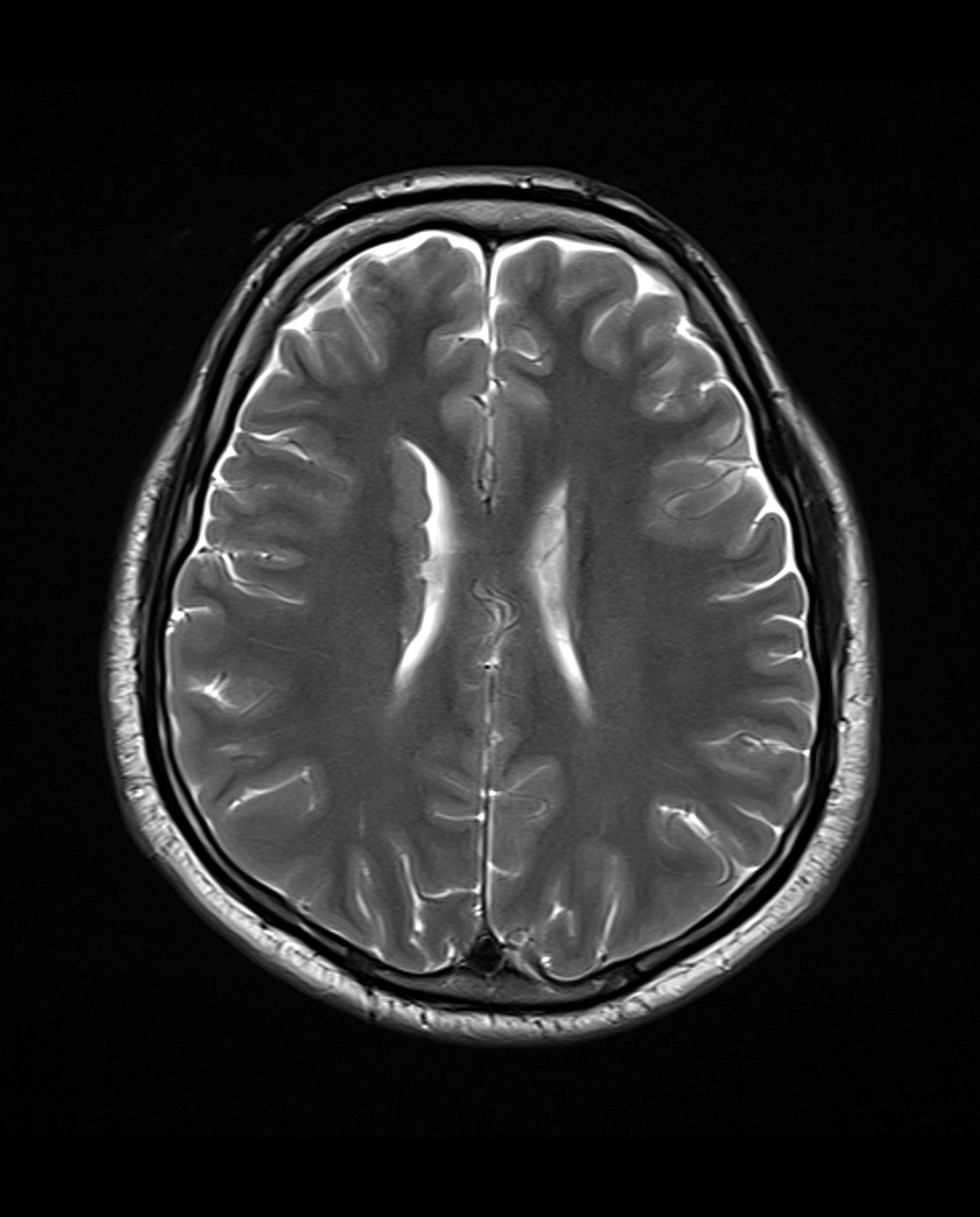 Subependymal grey matter heterotopia | Image | Radiopaedia.org