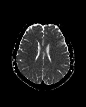 Subependymal grey matter heterotopia | Image | Radiopaedia.org