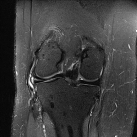 Osteopoikilosis | Image | Radiopaedia.org