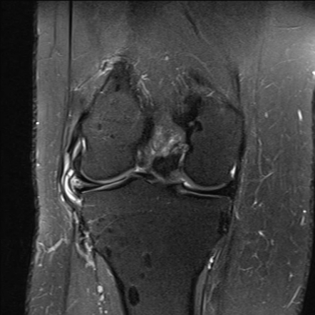 Horizontal meniscal tear | Radiology Reference Article | Radiopaedia.org