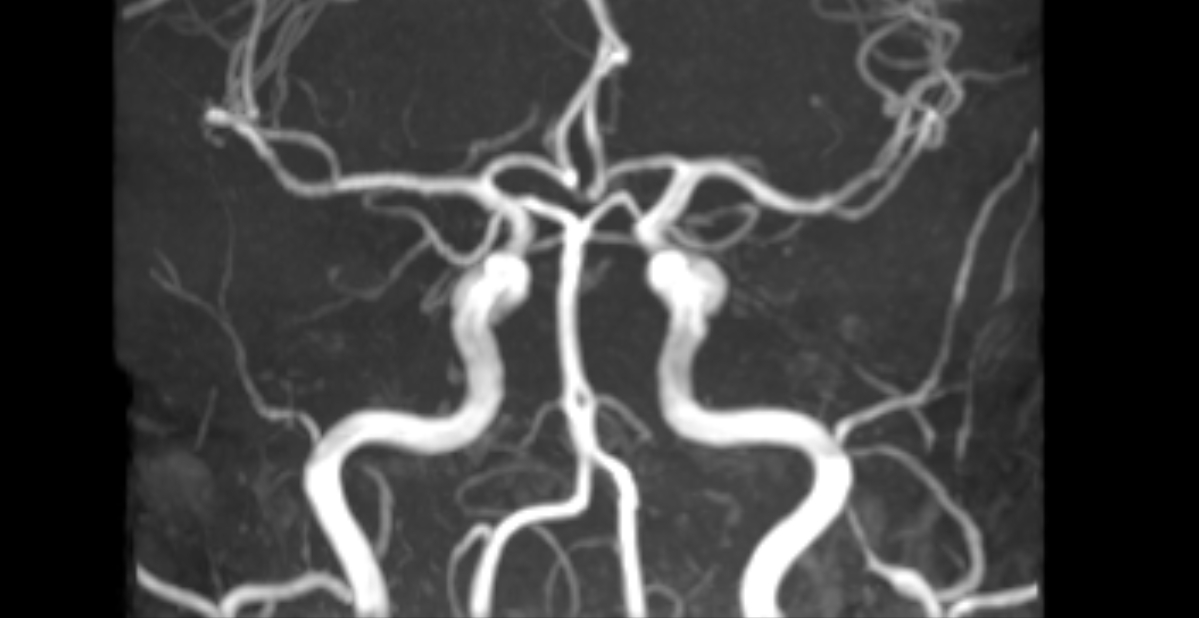 Basilar artery fenestration | Image | Radiopaedia.org