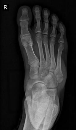 5th metatarsal avulsion fracture | Radiology Case | Radiopaedia.org