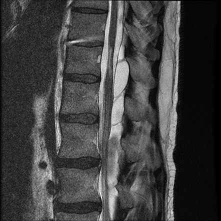 Spinal Arachnoid Cyst With Compressive Myelopathy | Radiology Case ...