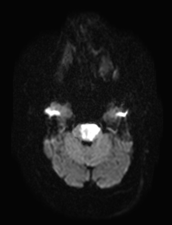 Basilar artery occlusion - brainstem infarction | Radiology Case ...