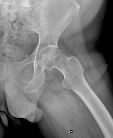 Avascular Necrosis Of The Hip - Crescent Sign Appearance 