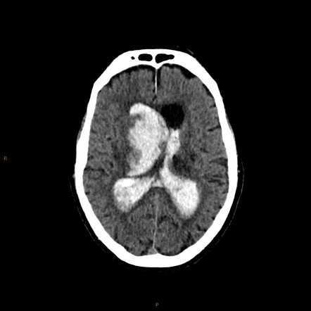 Intraventricular hemorrhage | Radiology Reference Article | Radiopaedia.org