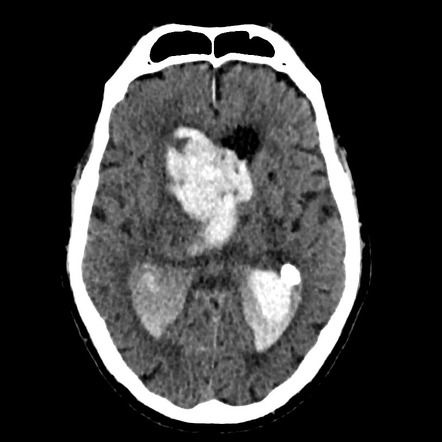 Unusual Case Of Spontaneous Bilateral Basal Ganglia Bleed, 51% OFF