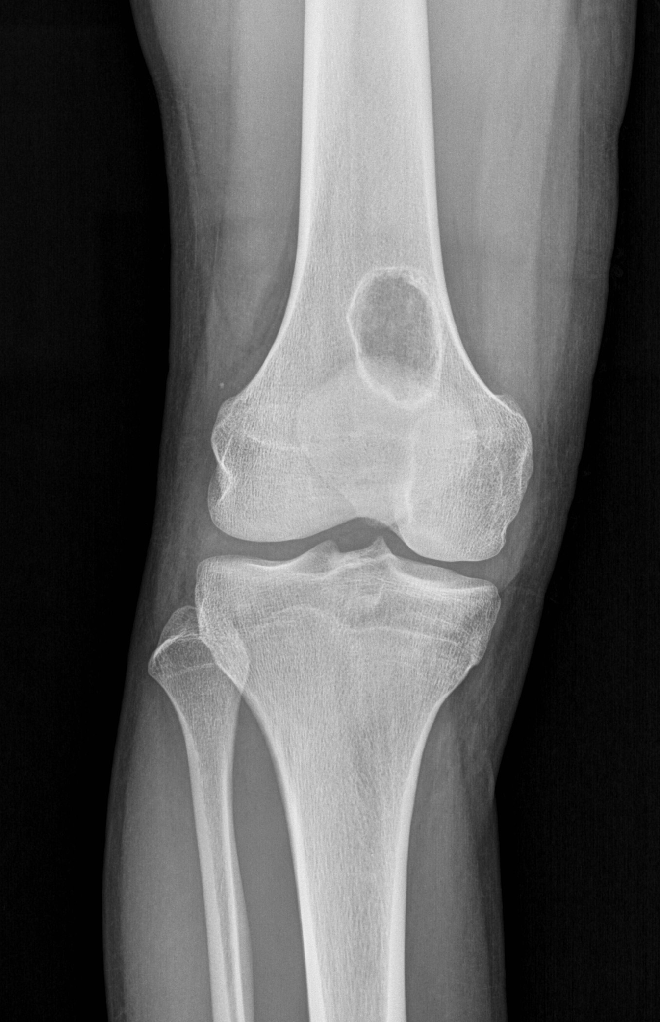 Non-ossifying fibroma | Image | Radiopaedia.org