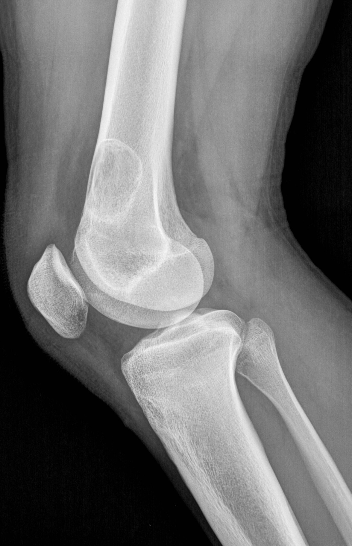 Non-ossifying fibroma | Image | Radiopaedia.org