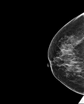 Accessory breast tissue | Image | Radiopaedia.org