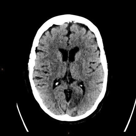 Left PCA territory infarct | Radiology Case | Radiopaedia.org