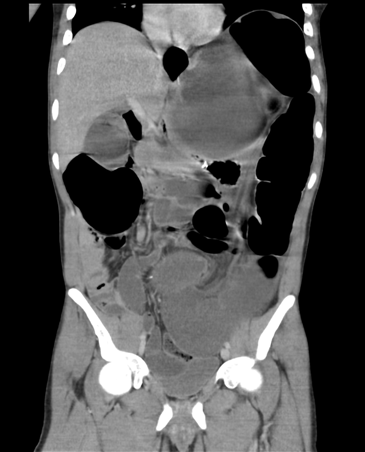 Sigmoid volvulus | Image | Radiopaedia.org