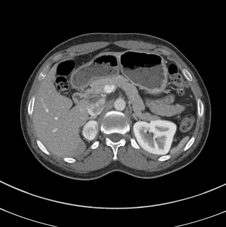 Pheochromocytoma | Image | Radiopaedia.org