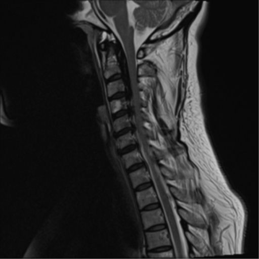 Ossification of the posterior longitudinal ligament (OPLL) | Image ...