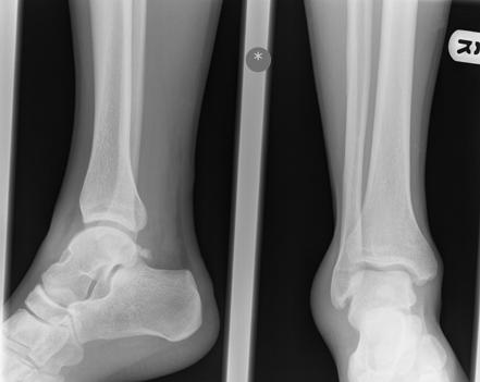 Os trigonum | Radiology Reference Article | Radiopaedia.org