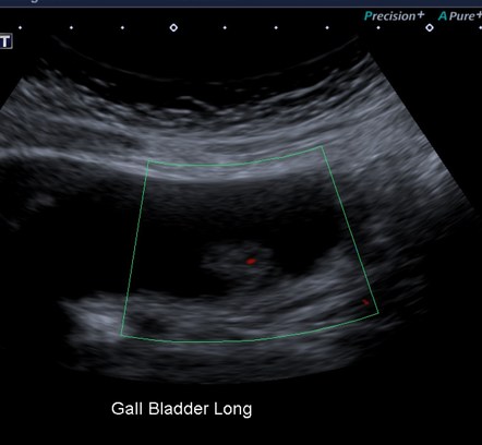 Gallbladder Polyp Histology