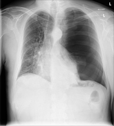 Large pneumothorax | Radiology Case | Radiopaedia.org