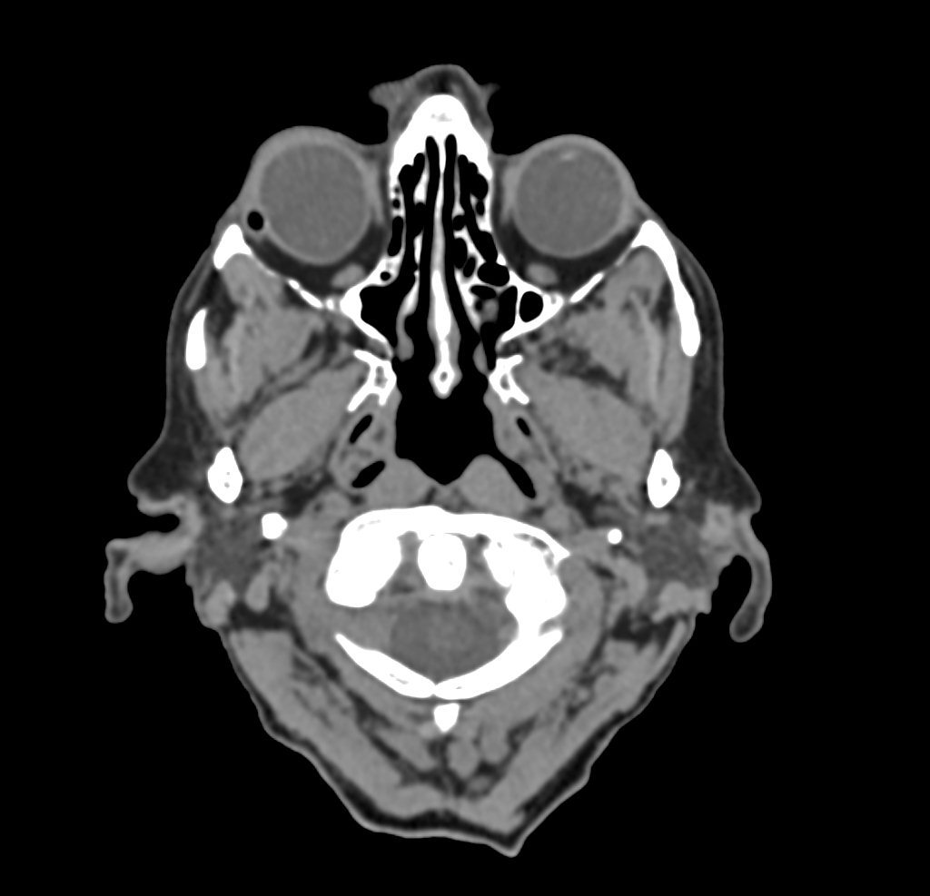 Staphyloma with right scleral buckle | Image | Radiopaedia.org