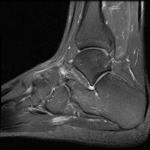 Anterior calcaneal process fracture | Image | Radiopaedia.org