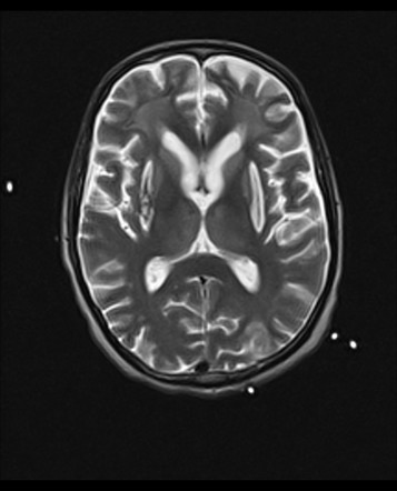 Toxic leukoencephalopathy | Radiology Reference Article | Radiopaedia.org