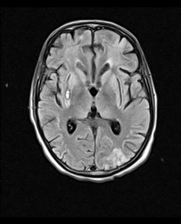 Methanol induced encephalopathy | Image | Radiopaedia.org