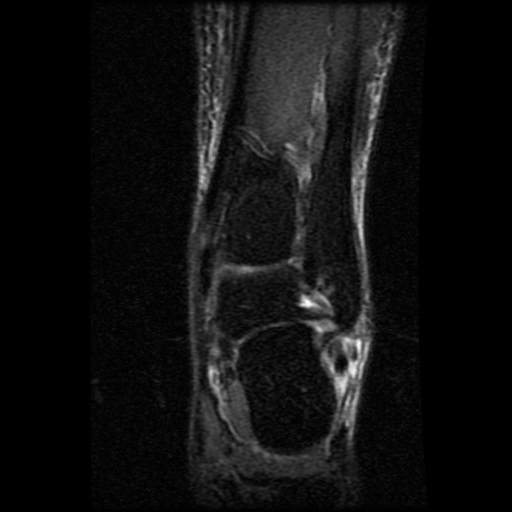 Split tear of the peroneus brevis tendon | Image | Radiopaedia.org