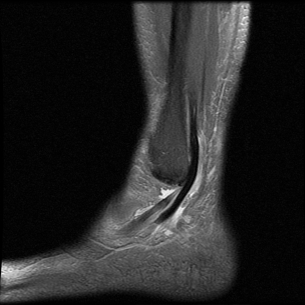 Split tear of the peroneus brevis tendon | Image | Radiopaedia.org