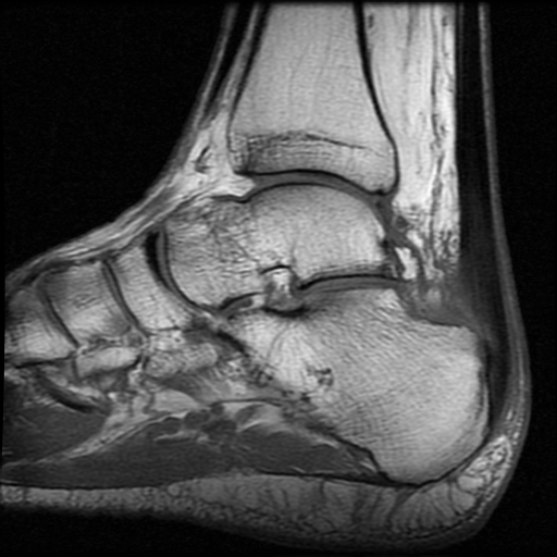 Achilles tendinopathy and peritendonitis | Image | Radiopaedia.org