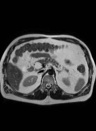 Pancreatic lipoma | Radiology Case | Radiopaedia.org