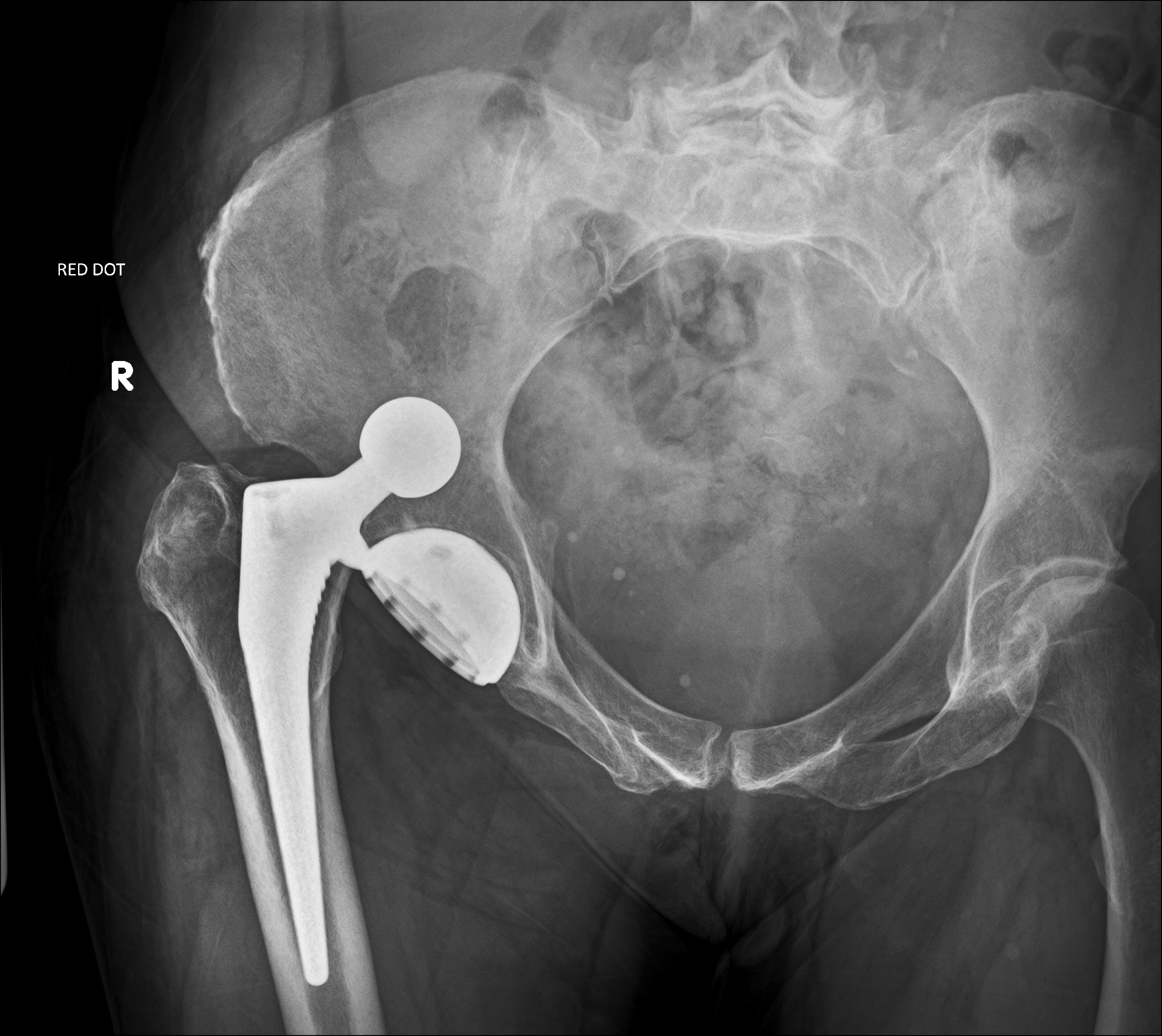 Dislocation of hip replacement | Image | Radiopaedia.org