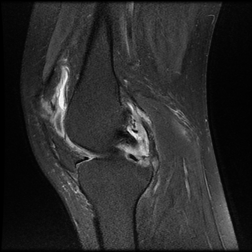 Knee synovitis - rheumatoid arthritis | Image | Radiopaedia.org