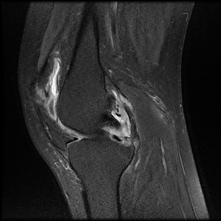 Knee synovitis - rheumatoid arthritis | Image | Radiopaedia.org