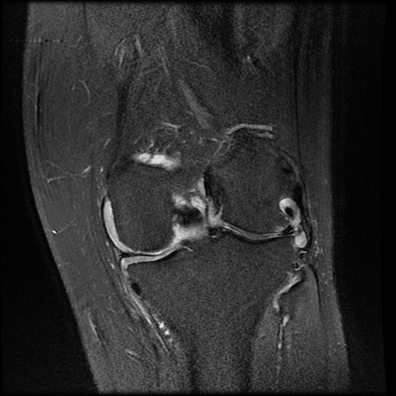 Knee synovitis - rheumatoid arthritis | Image | Radiopaedia.org