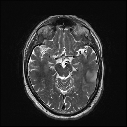 Glioblastoma - early | Image | Radiopaedia.org