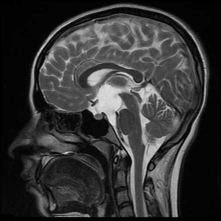 Suprasellar arachnoid cyst | Radiology Reference Article | Radiopaedia.org