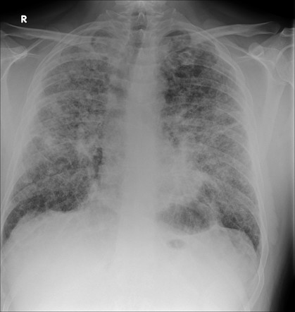 Sarcoidosis - stage IV | Radiology Case | Radiopaedia.org