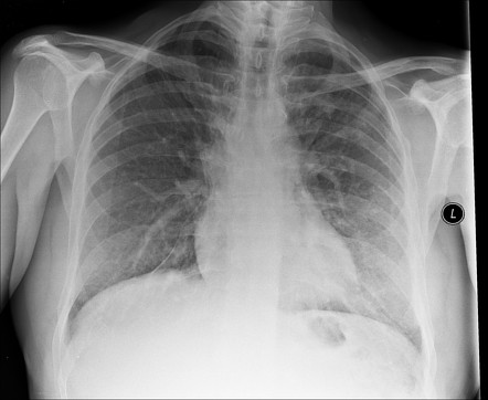 Radiation-induced pulmonary fibrosis | Radiology Reference Article ...