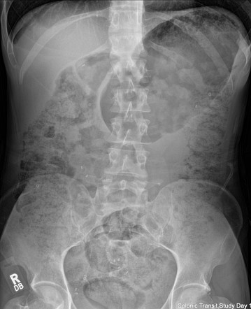 Colonic Transit Study Radiology Reference Article Radiopaedia Org