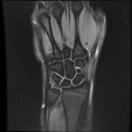 Os centrale carpi | Radiology Reference Article | Radiopaedia.org