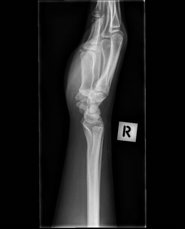 Trapezium fracture | Image | Radiopaedia.org