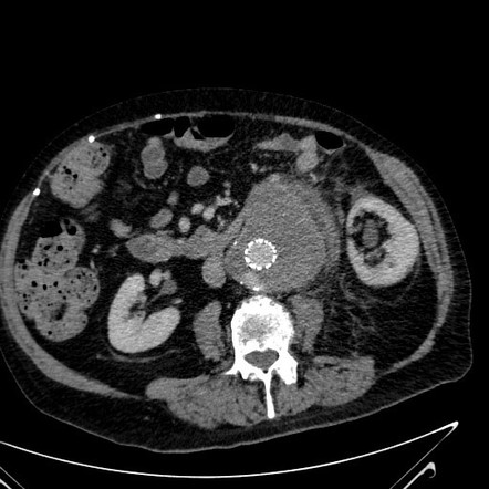 Endoleak - type II | Radiology Case | Radiopaedia.org