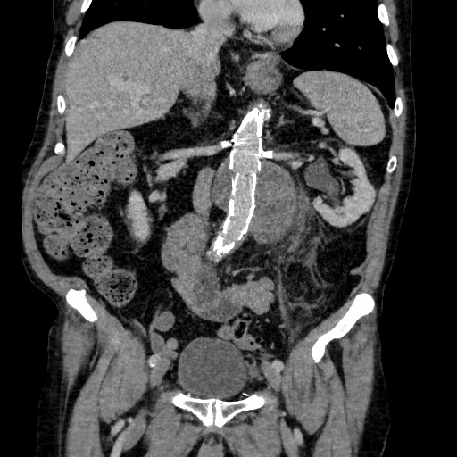 Endoleak Type Ii Image Radiopaedia Org