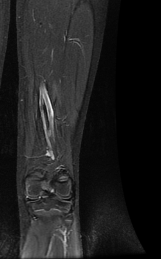 Non-ossifying fibroma | Image | Radiopaedia.org