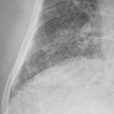 Kerley B Lines Pulmonary Edema