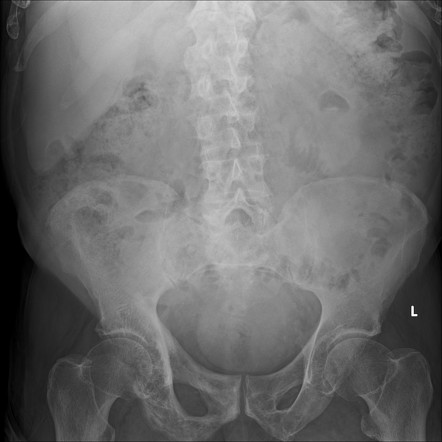 Paget disease | Radiology Case | Radiopaedia.org