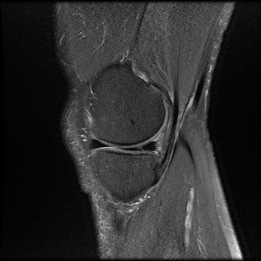 Parrot beak meniscal tear | Image | Radiopaedia.org