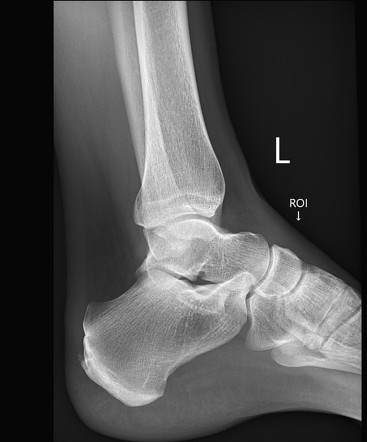 Midtarsal sprain | Image | Radiopaedia.org